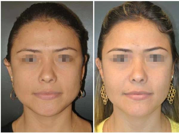 Bichectomia antes e depois em Ponta Grossa — Caso 1