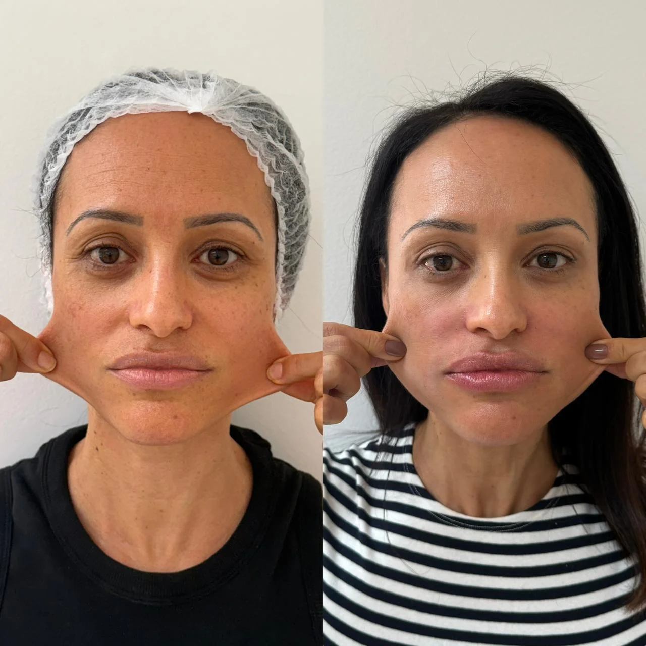 Bioestimuladores antes e depois em Ponta Grossa — Caso 1