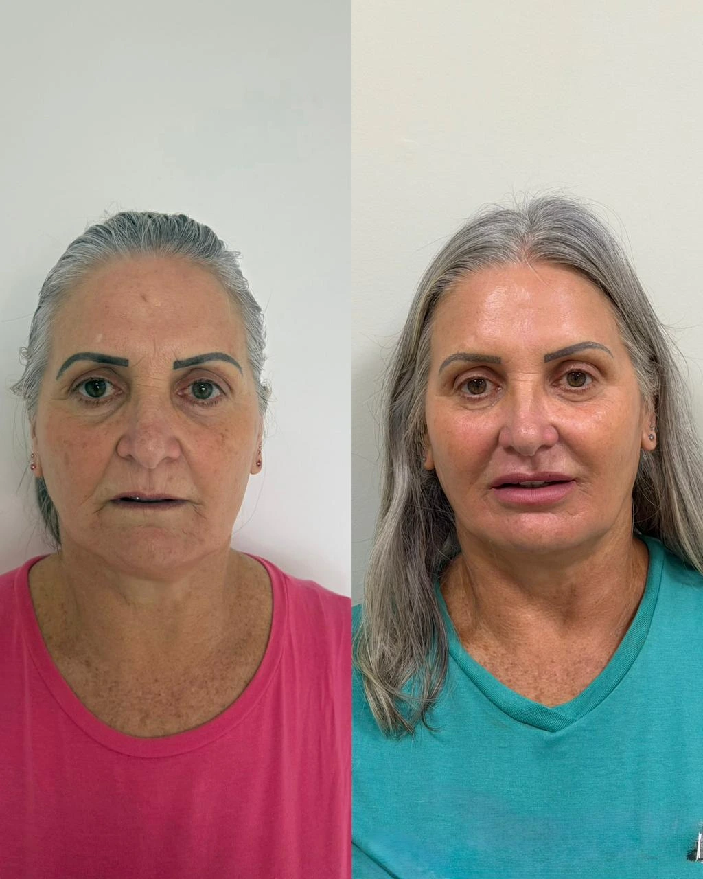 Bioestimuladores antes e depois em Ponta Grossa — Caso 3