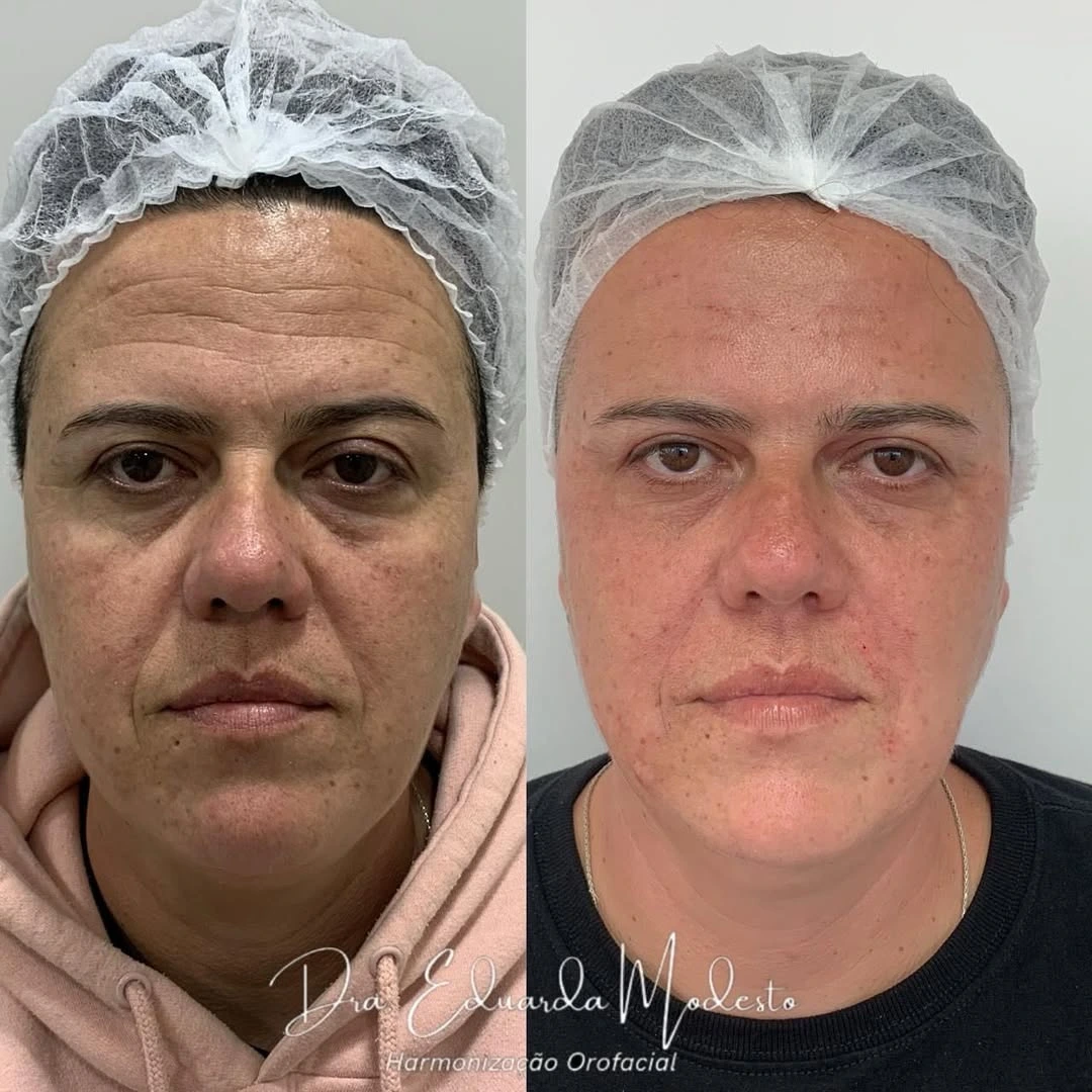Botox antes e depois em Ponta Grossa — Caso 1