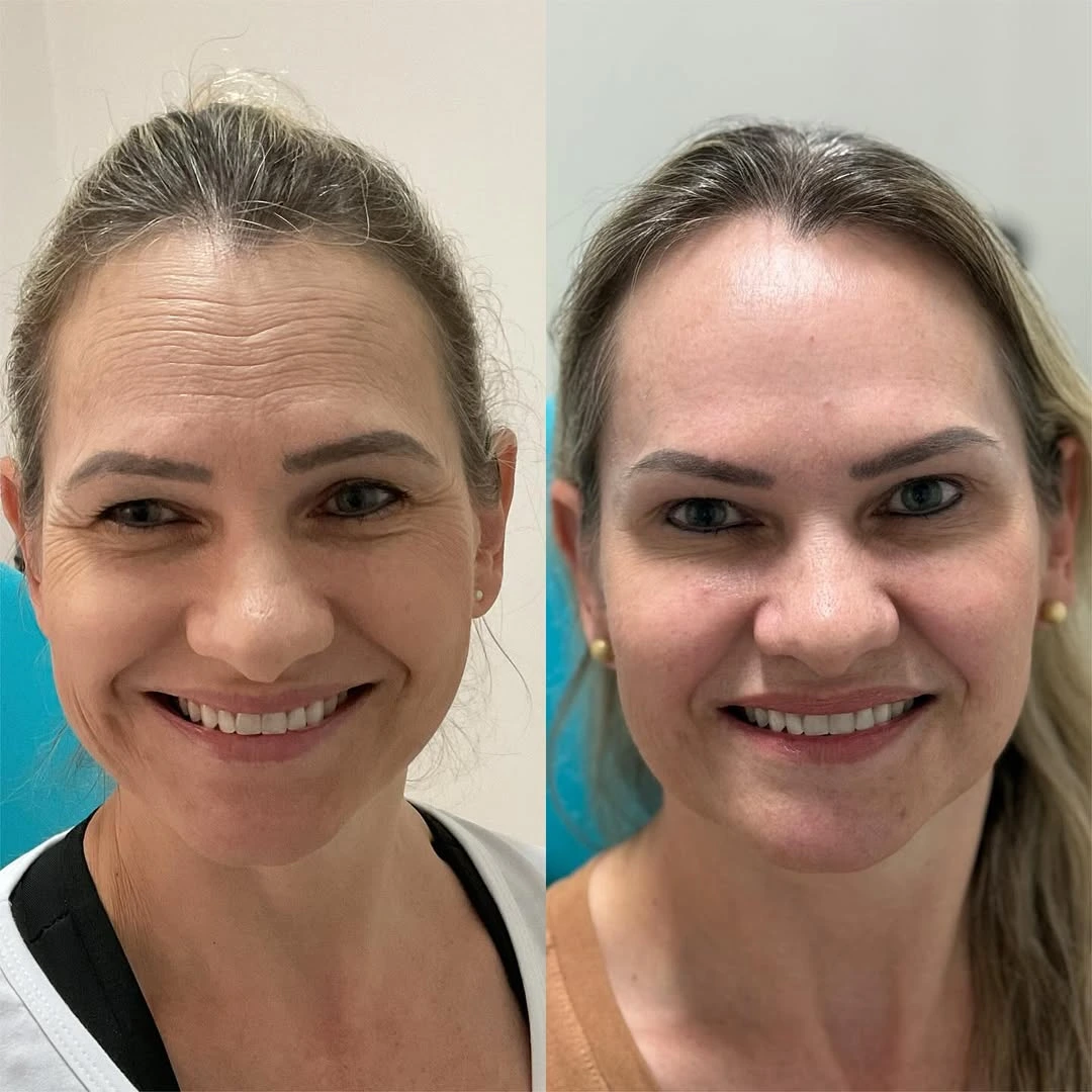 Botox antes e depois em Ponta Grossa — Caso 2