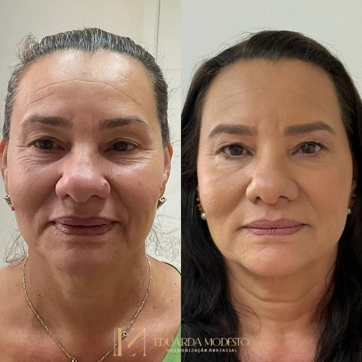 Botox — resultado 3