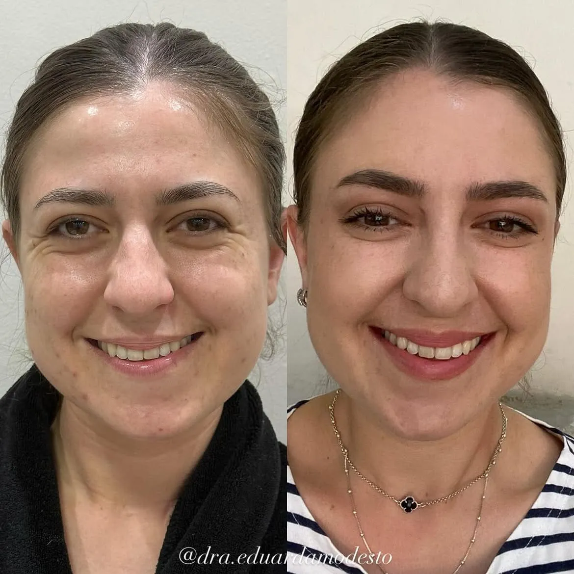 Botox — resultado 4