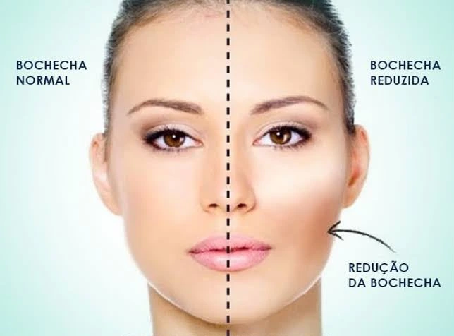 Comparação ilustrativa entre bochecha normal e bochecha reduzida após bichectomia