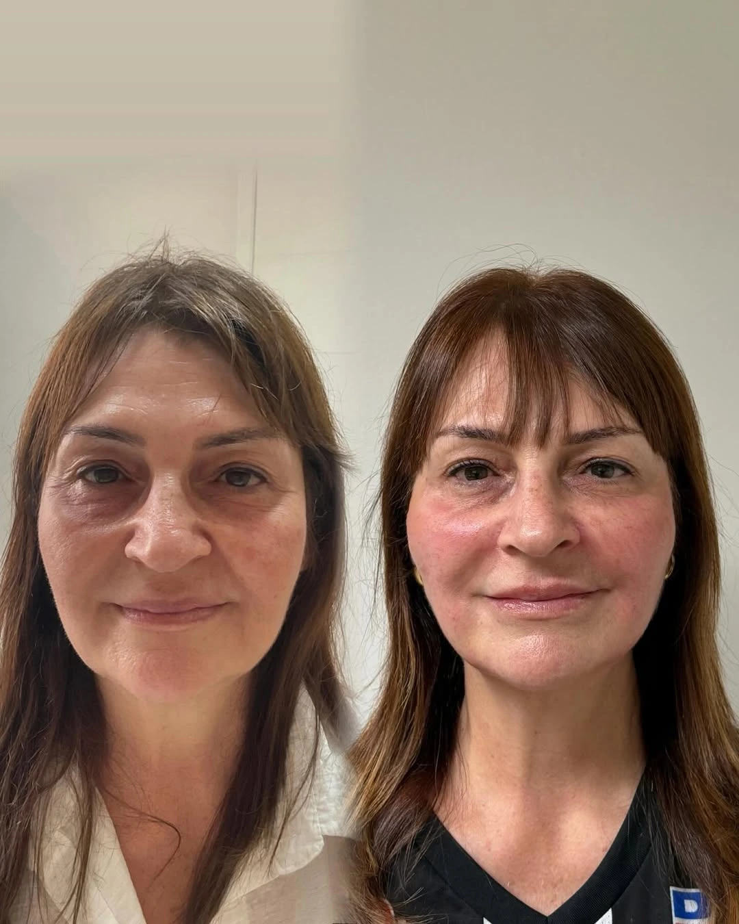 Harmonização Facial — resultado 1