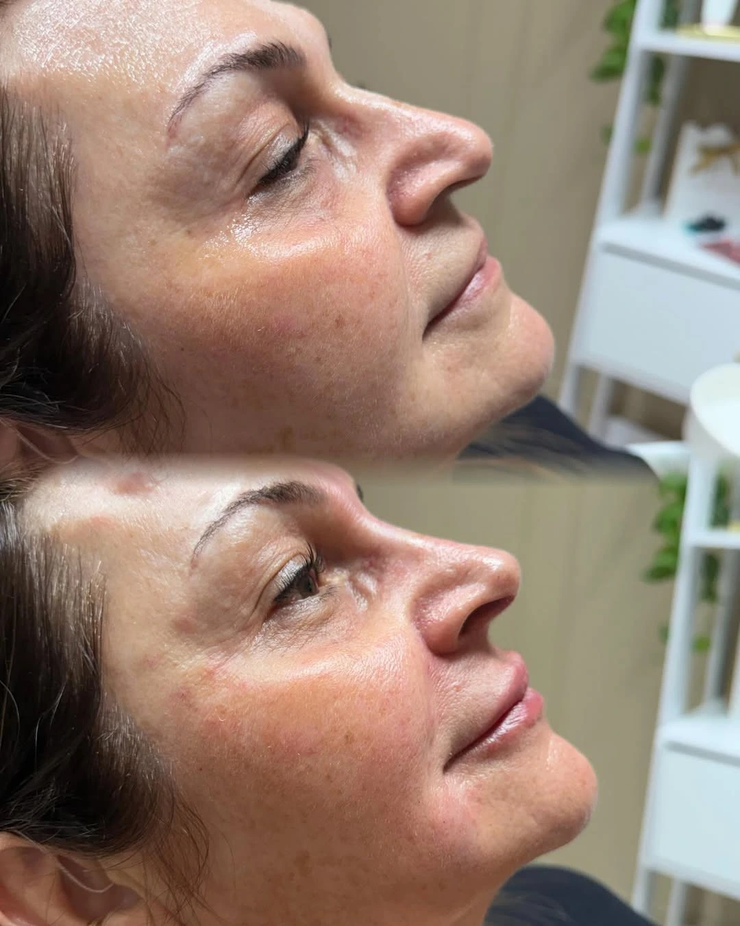 Harmonização Facial — resultado 2