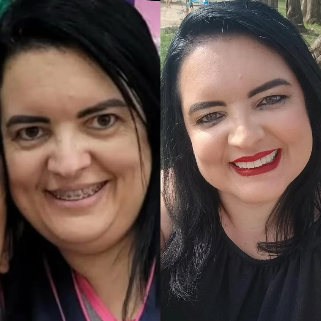 Harmonização Facial — resultado 3