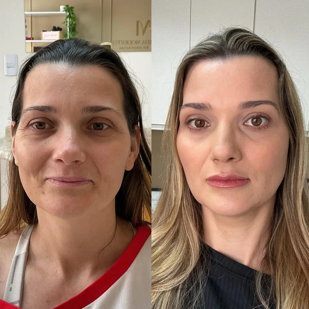 Harmonização Facial — resultado 4