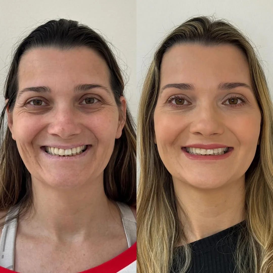 Harmonização Facial — resultado 5