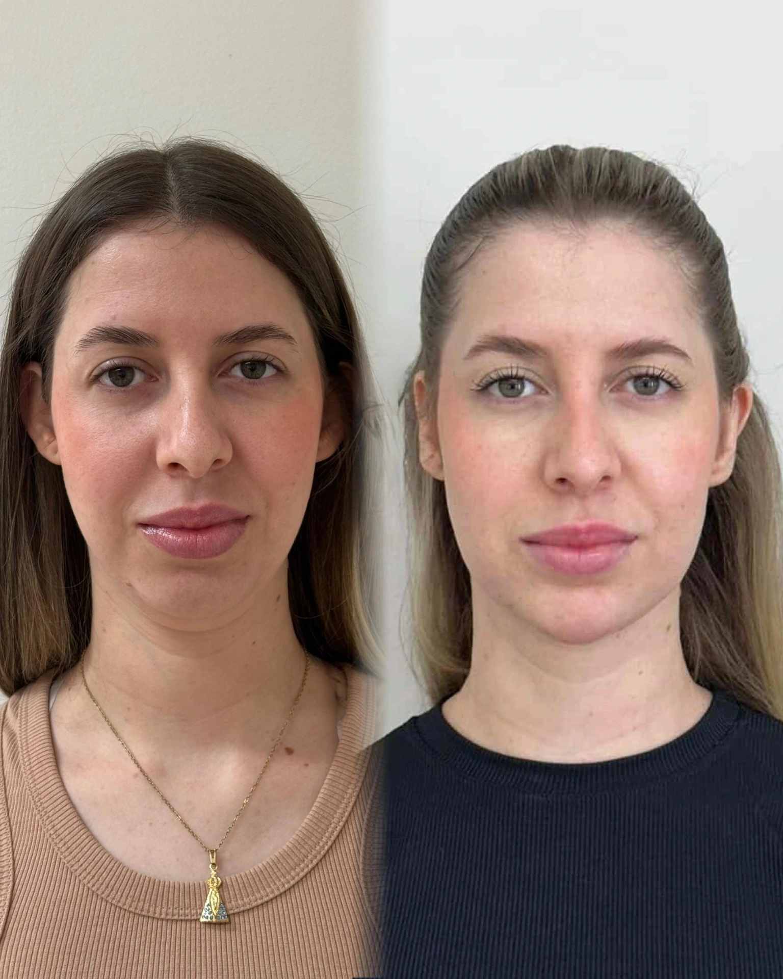 Lipo de papada antes e depois em Ponta Grossa — Caso 2