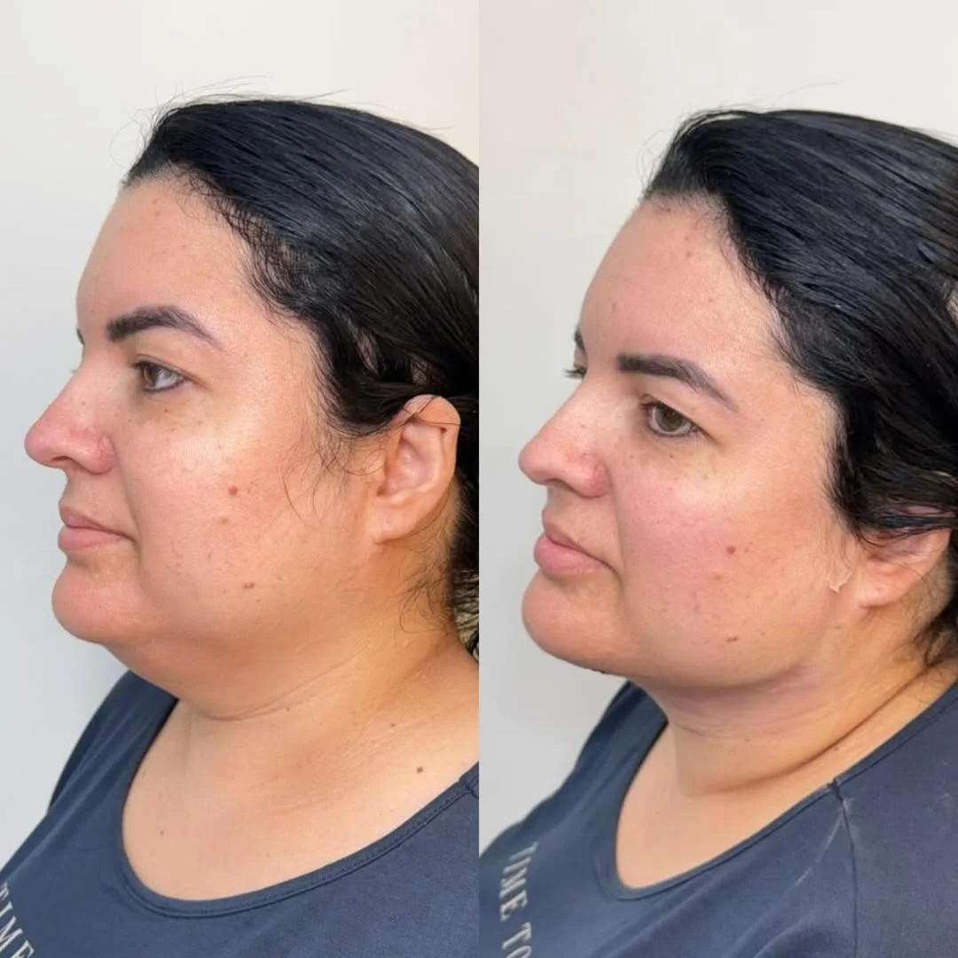 Lipo de Papada — resultado 3