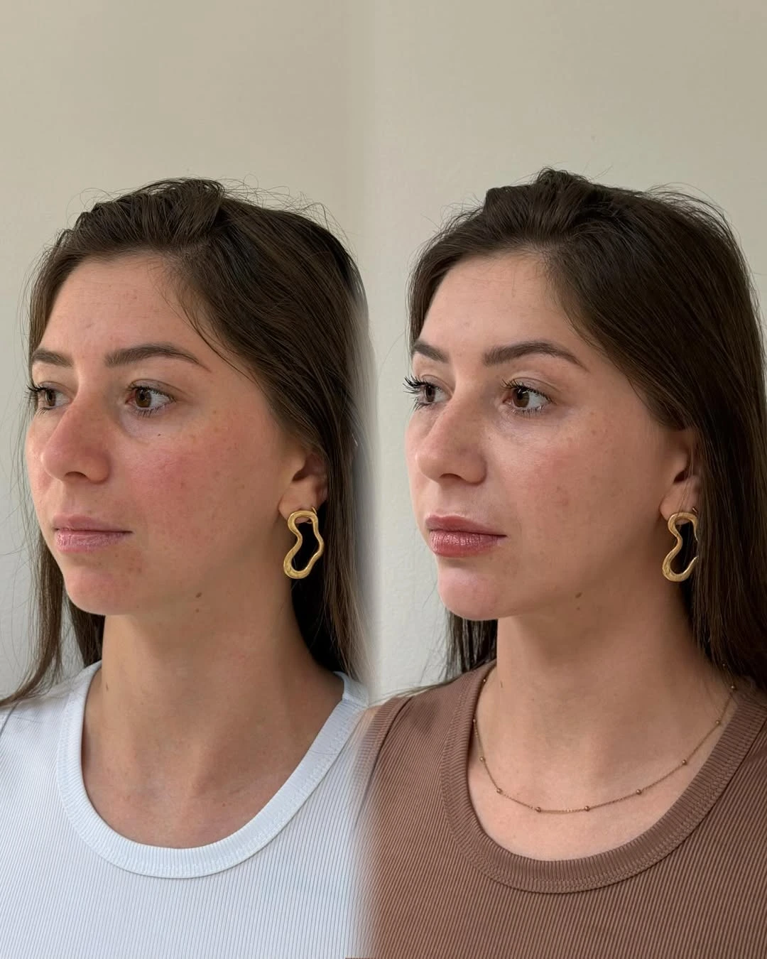 Preenchimento labial antes e depois em Ponta Grossa — Caso 1