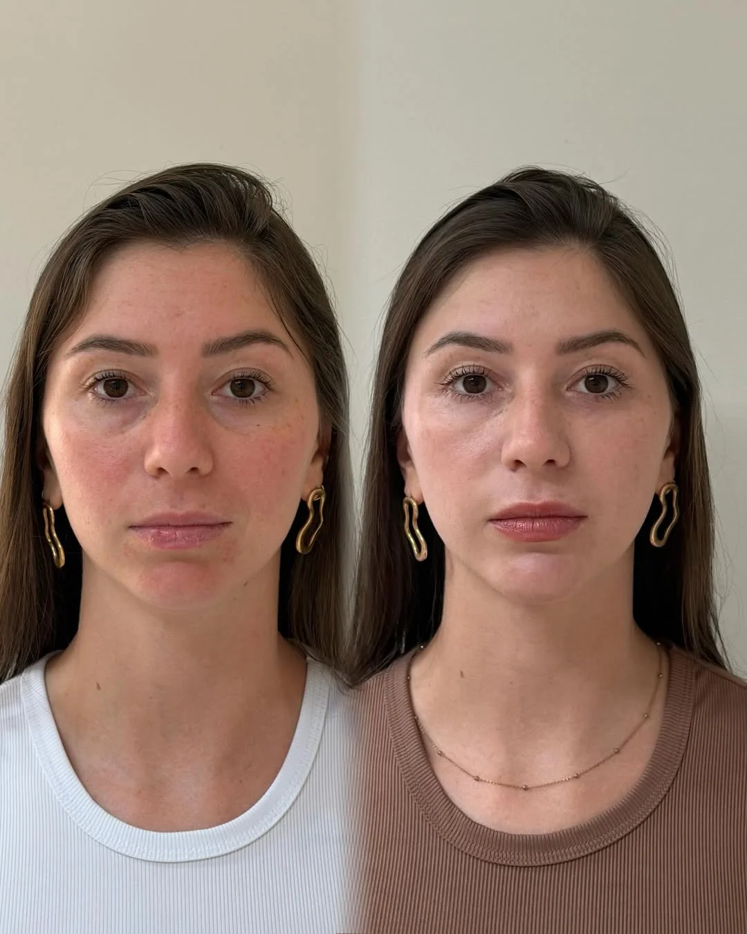 Preenchimento labial antes e depois em Ponta Grossa — Caso 2
