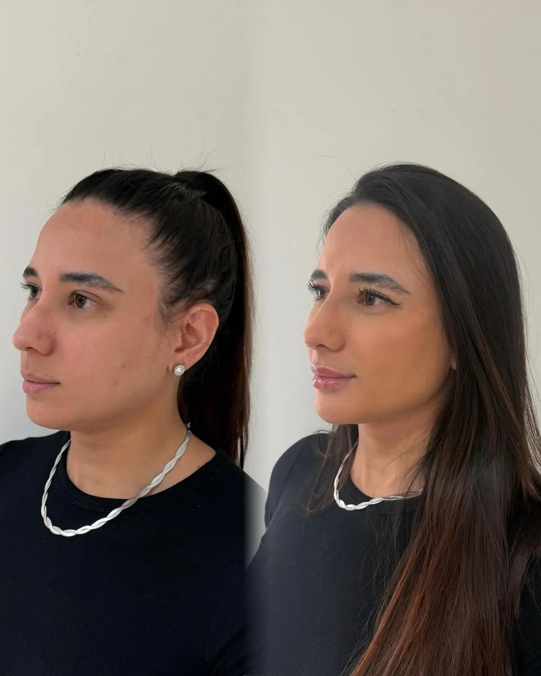 Preenchimento labial antes e depois em Ponta Grossa — Caso 3