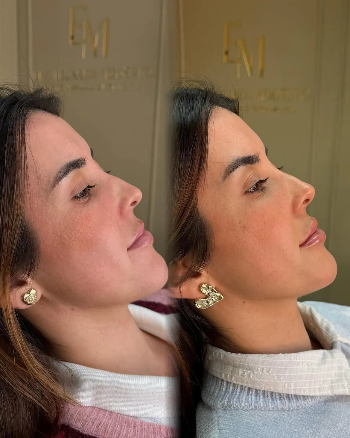 Preenchimento Labial — resultado 4