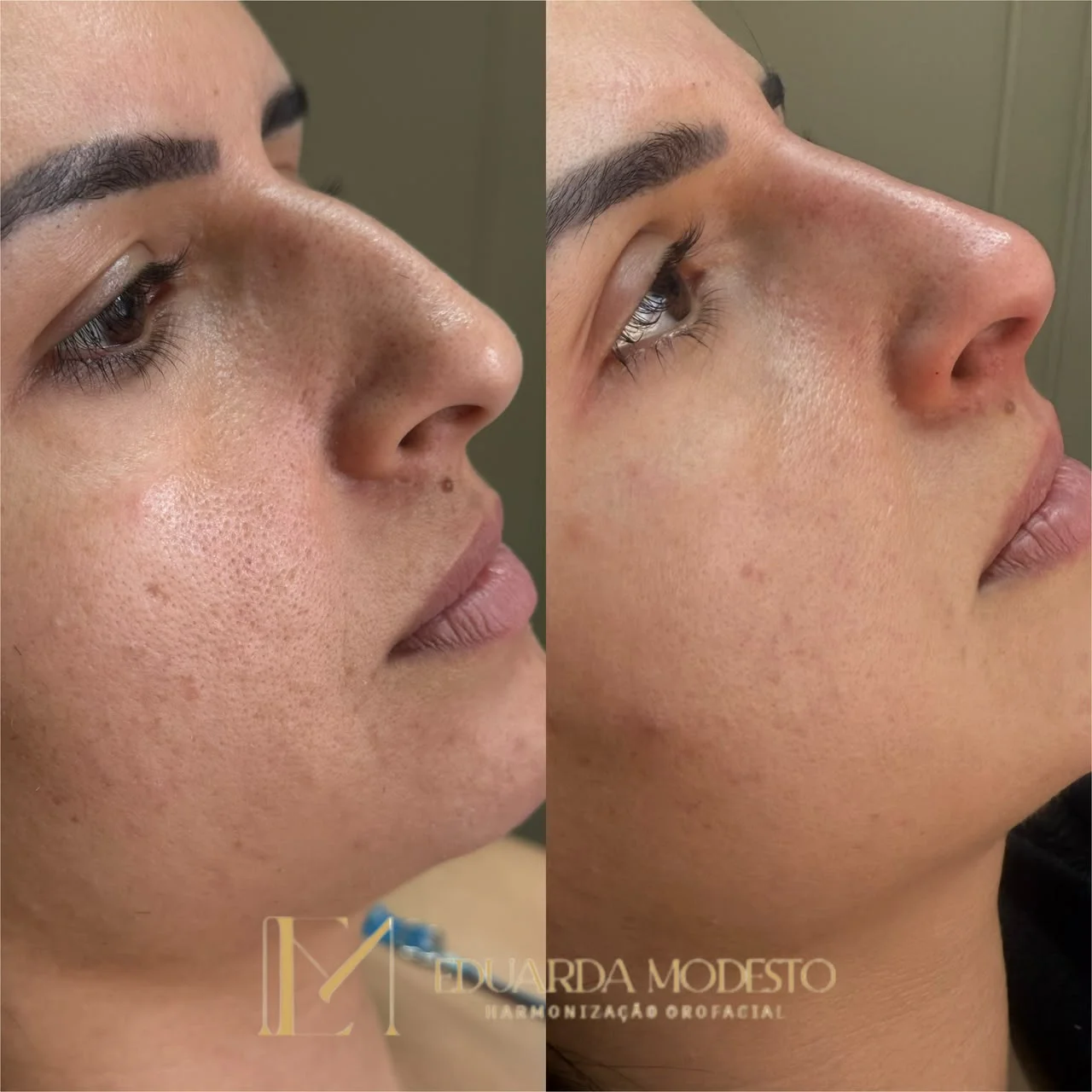 Rinomodelação antes e depois em Ponta Grossa — Caso 2